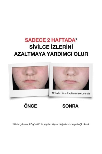 Neutrogena Sivilce Karşıtı Plus Serum 30 ml